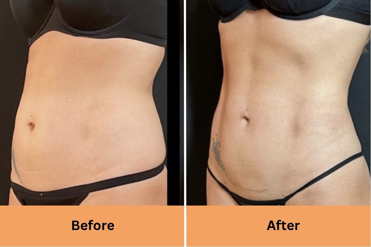 Radio Frequency Tummy Tightening 1