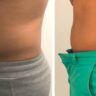 Fat Freezing Results
