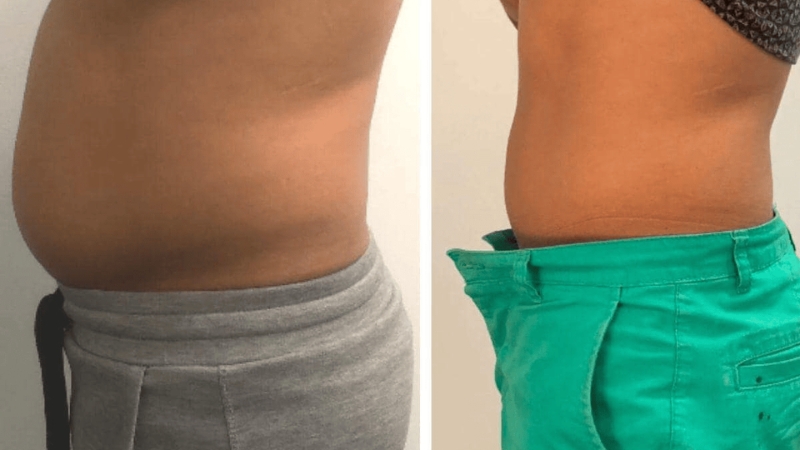 Fat Freezing Results