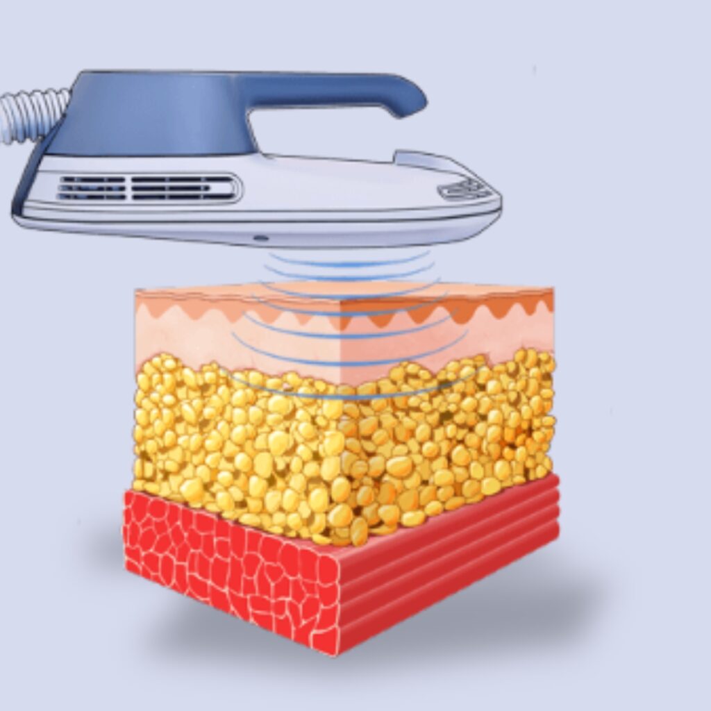 emsculpt treatment in mumbai