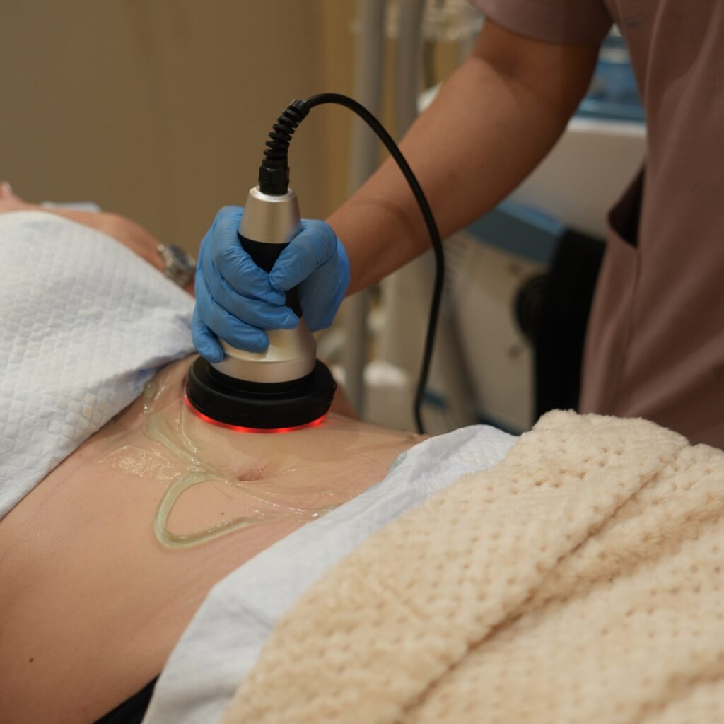Ultrasonic cavitation treatment being applied to a patient's abdomen for fat reduction.