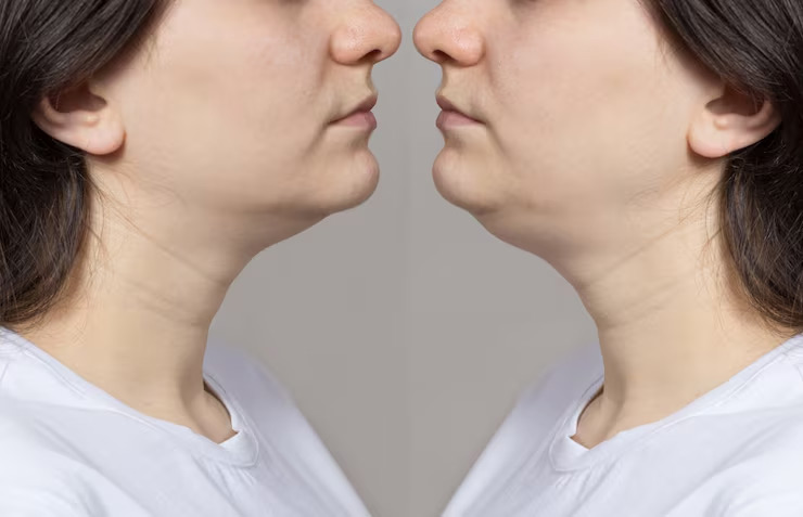 double chin removal non surgical