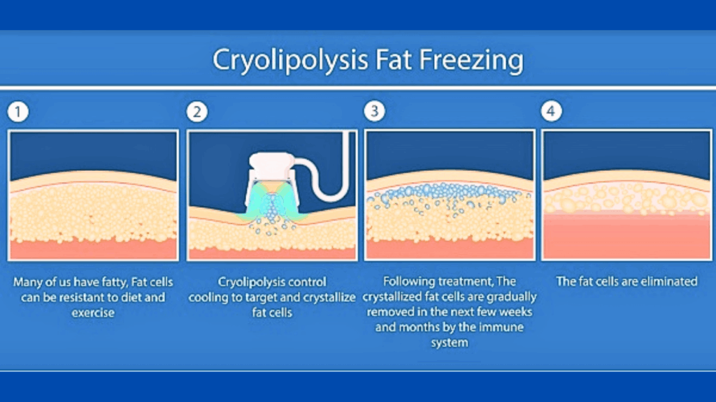 Does Fat Freezing Treatment in Mumbai Really Work? Real Results, Science, and What to Expect 1 Process of Cryolipolysis Treatment