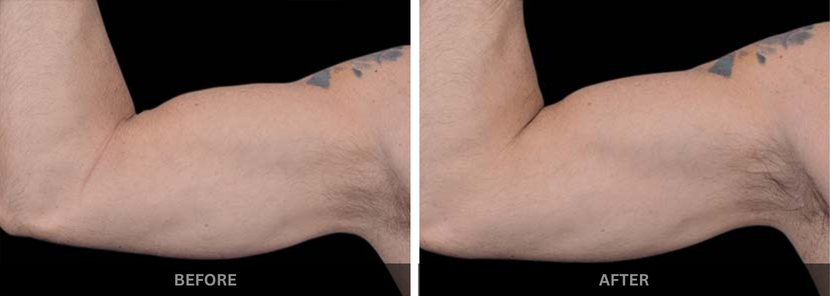 emsculpt abs treatment mumbai