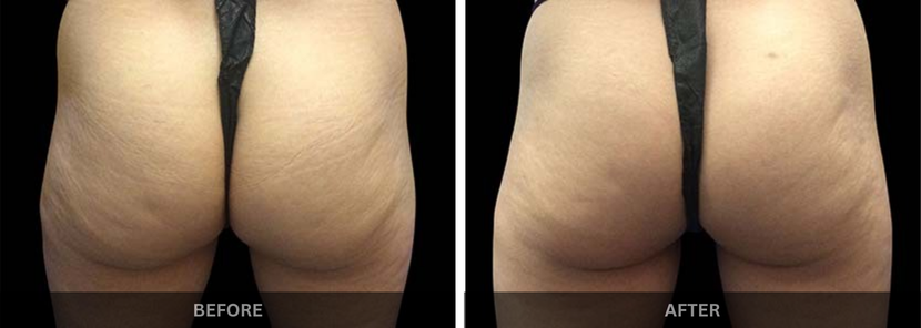 emsculpt body contouring mumbai