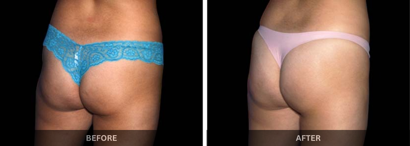 emsculpt body sculpting mumbai