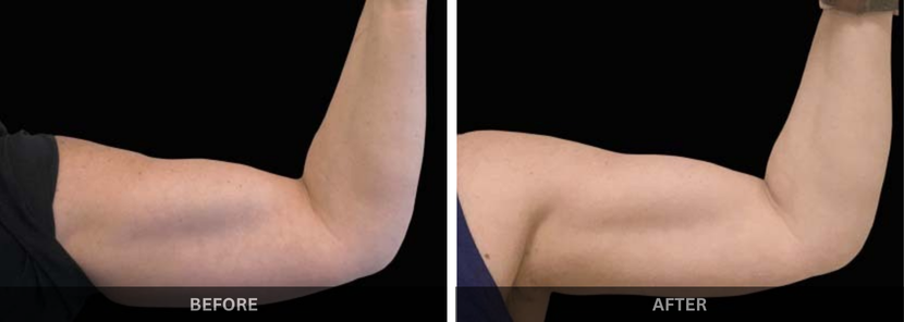 emsculpt fat reduction mumbai