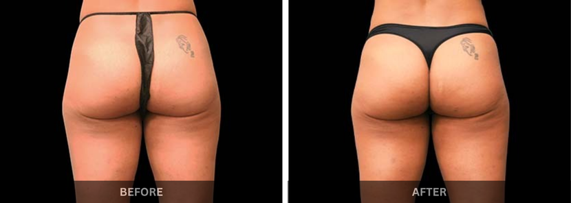 emsculpt treatment in mumbai