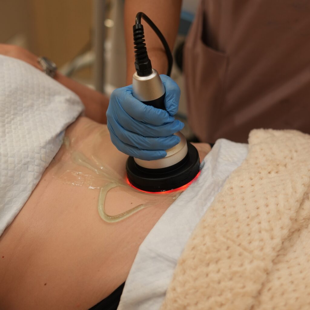 fat freezing