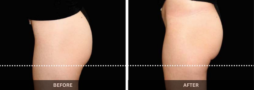 fat freezing emsculpt treatment in mumb
