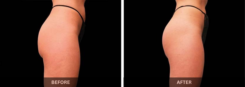 fat freezing emsculpt treatment in mumba