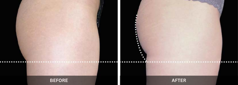fat freezing emsculpt treatment in mumbai