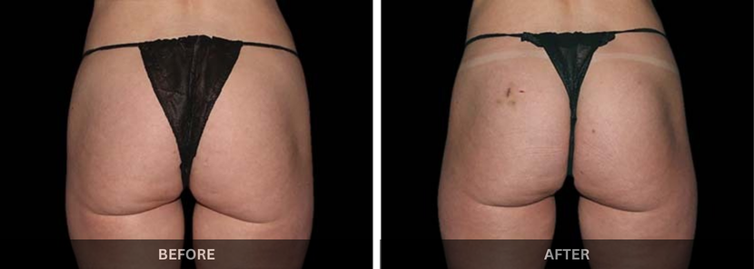 fat freezing emsculpt treatment mumbai