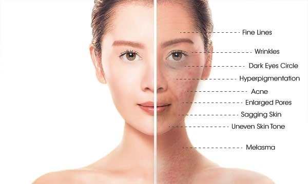 fat freezing what plasma can treat