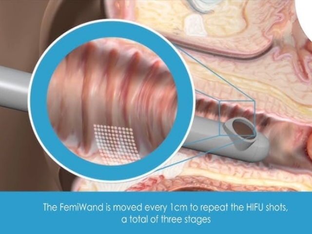 vaginal tightening works by stimulating collagen inside vaginal walls