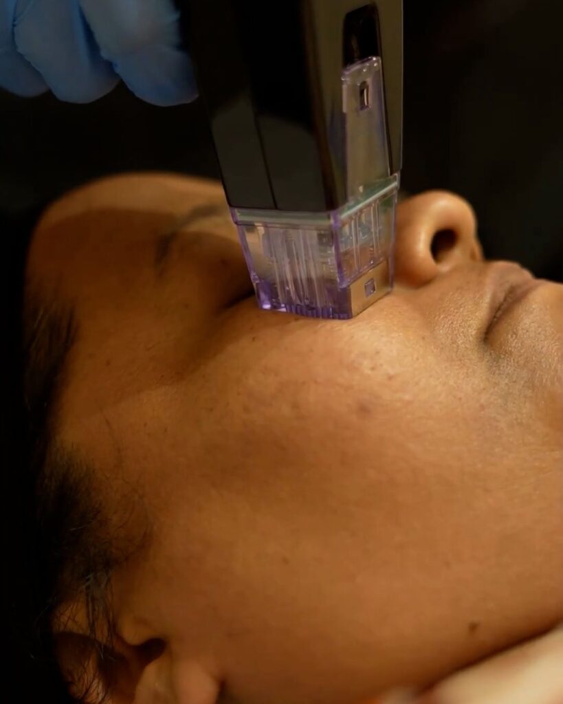 Morpheus8 Treatment in Mumbai