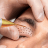 Plasma Eye Lift Mumbai – Non-Surgical Eyelid Tightening Treatment