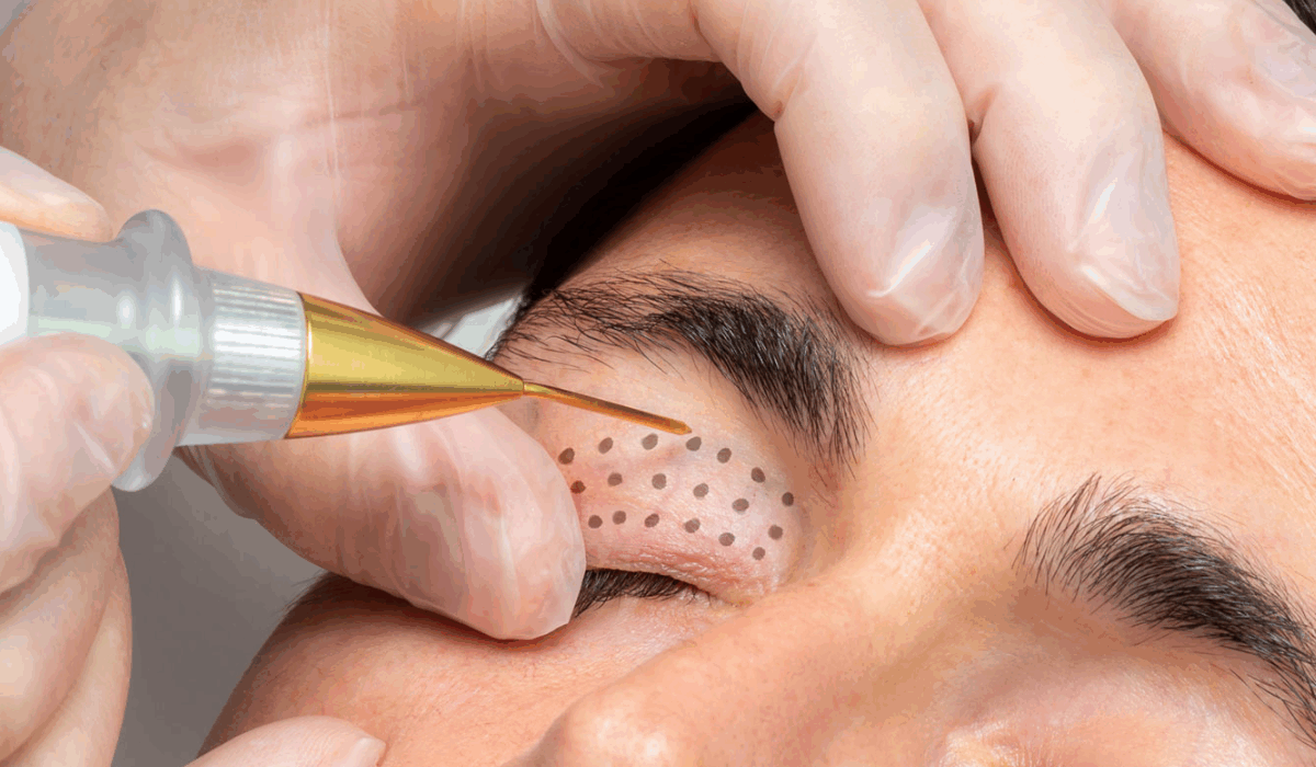 Plasma Eye Lift Mumbai – Non-Surgical Eyelid Tightening Treatment