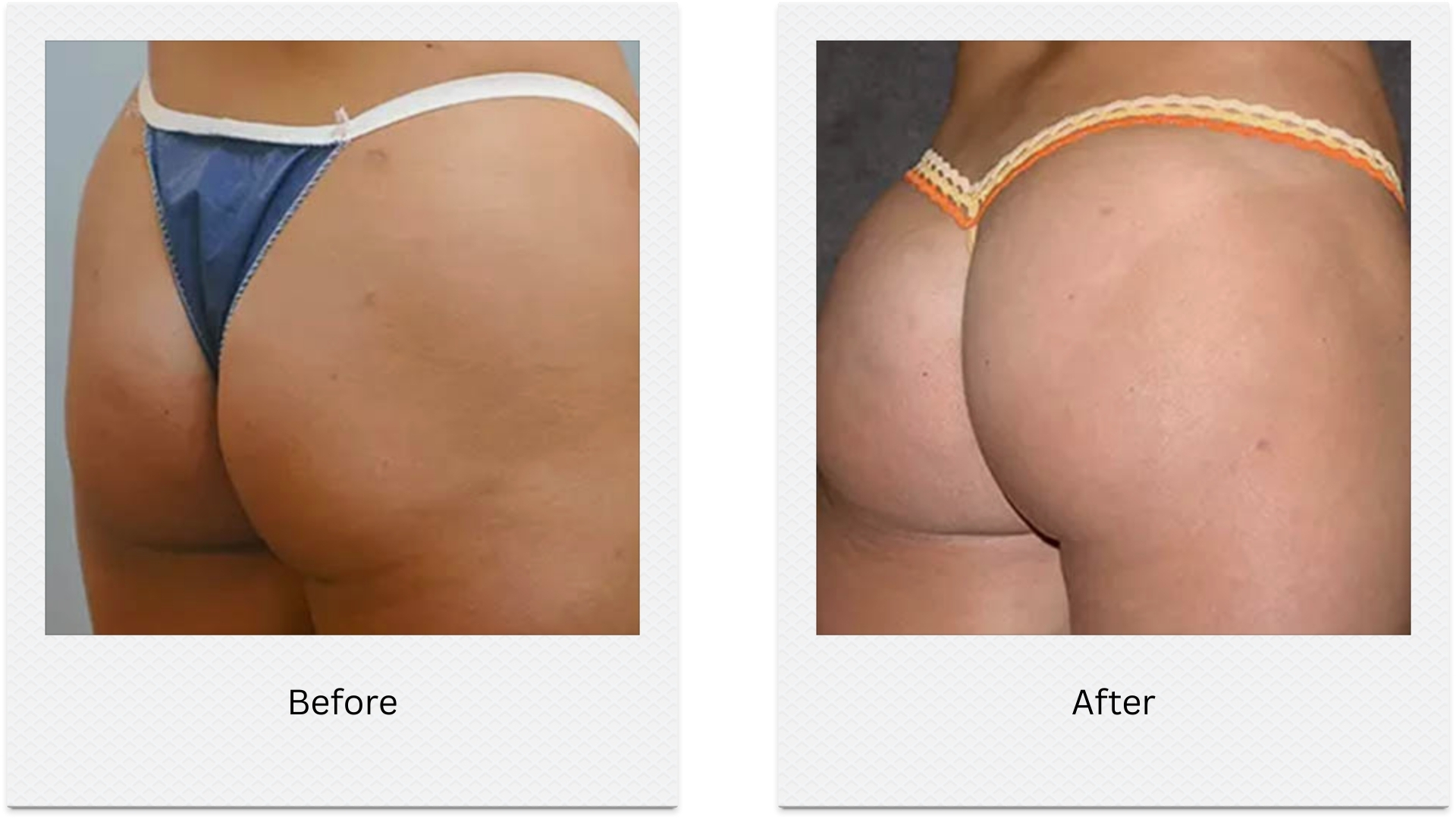 Brazilian bum lift non surgical before after side profile enhancement