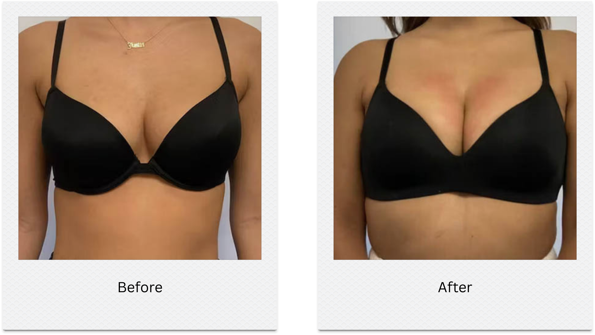 breast lift non surgical volume enhancement before after