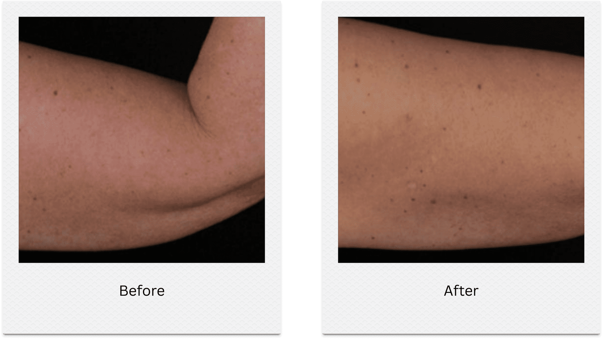 Fat freezing arm before and after results showing reduction in arm fat
