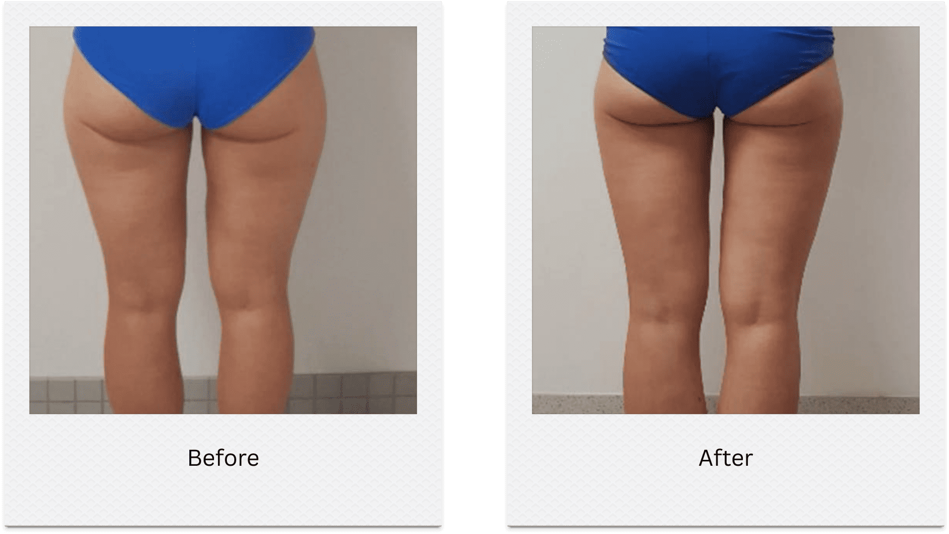 Buttocks fat freezing before after results showing smoother contour