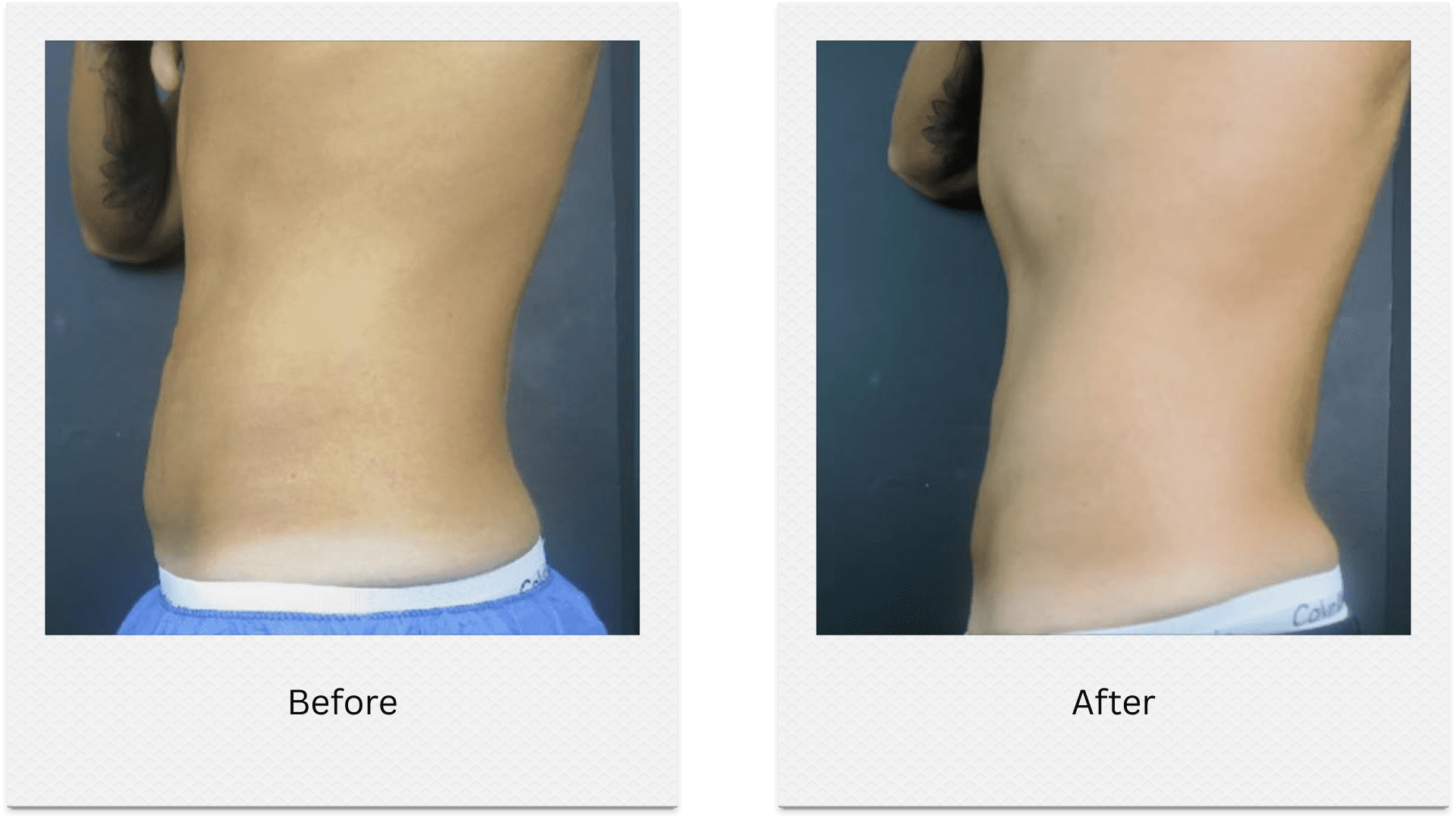 Flanks fat freezing before after waist slimming results