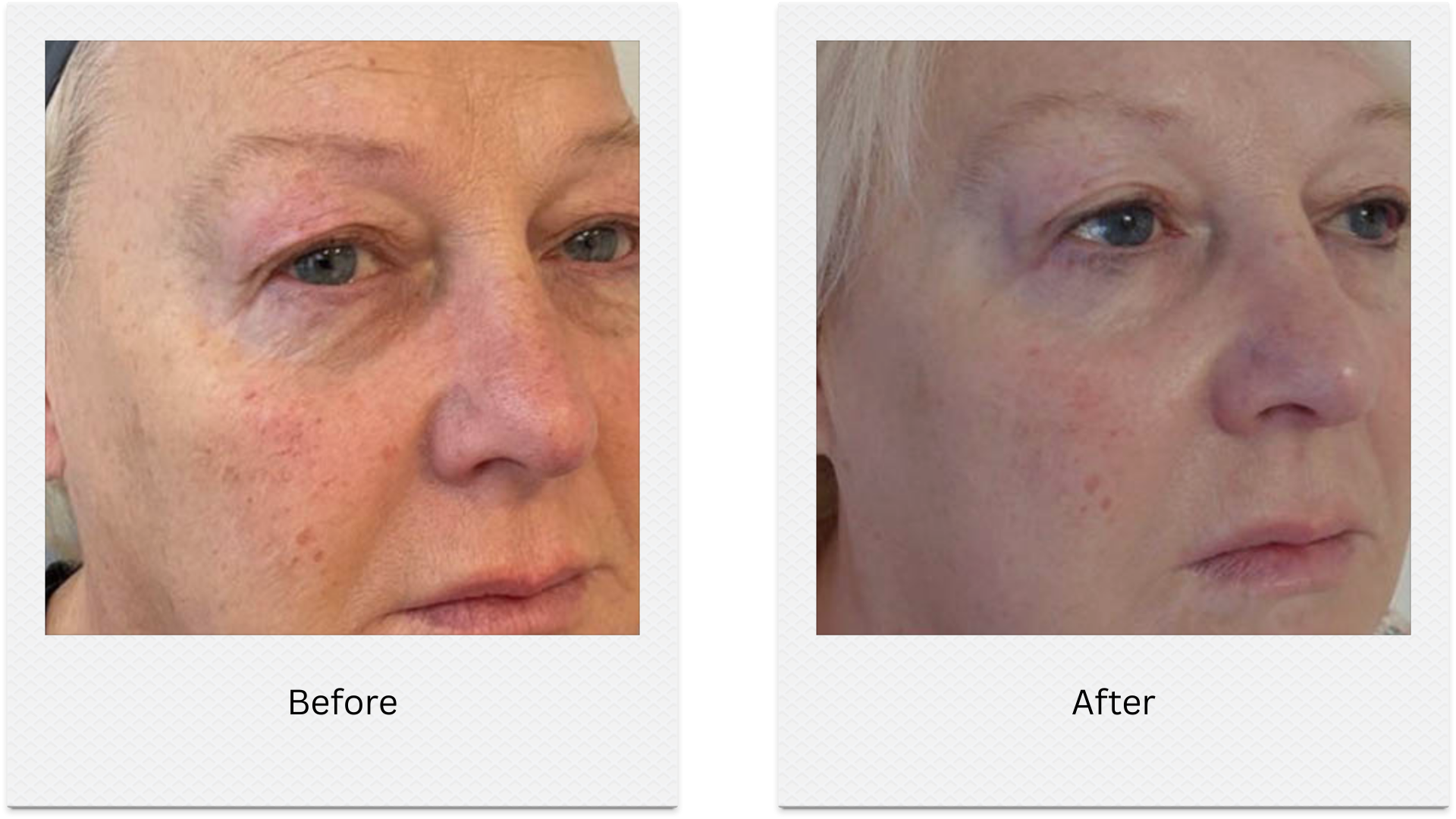hifu facelift before after full face