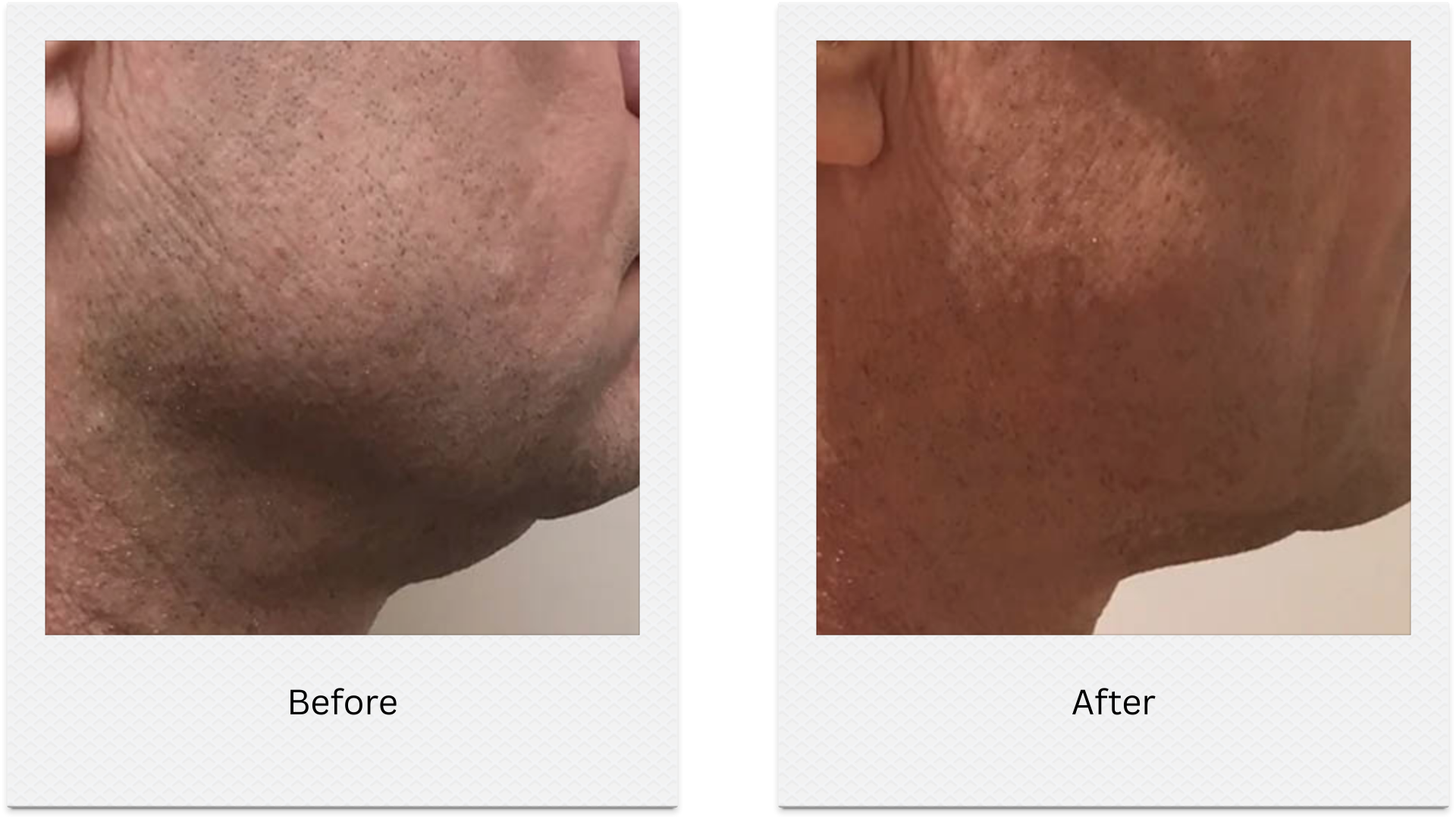 hifu jawline tightening before after