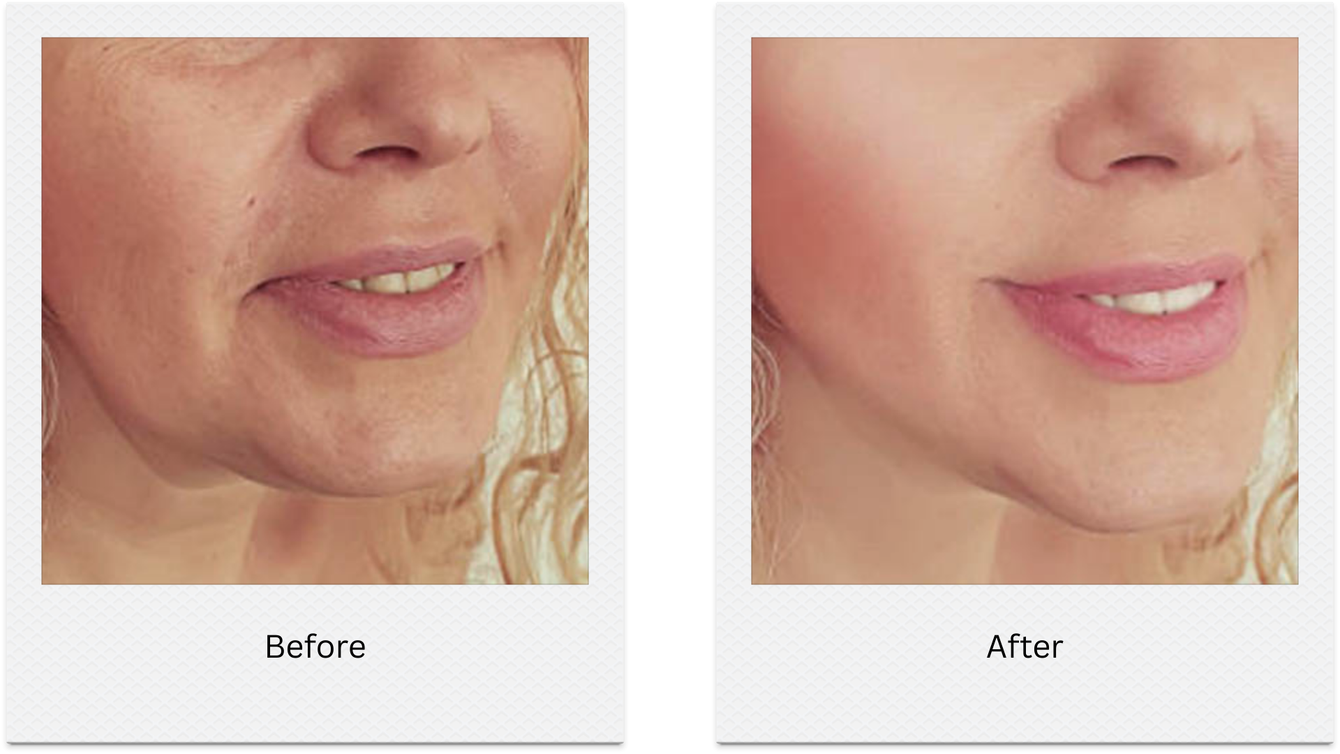 hifu lower face tightening before after