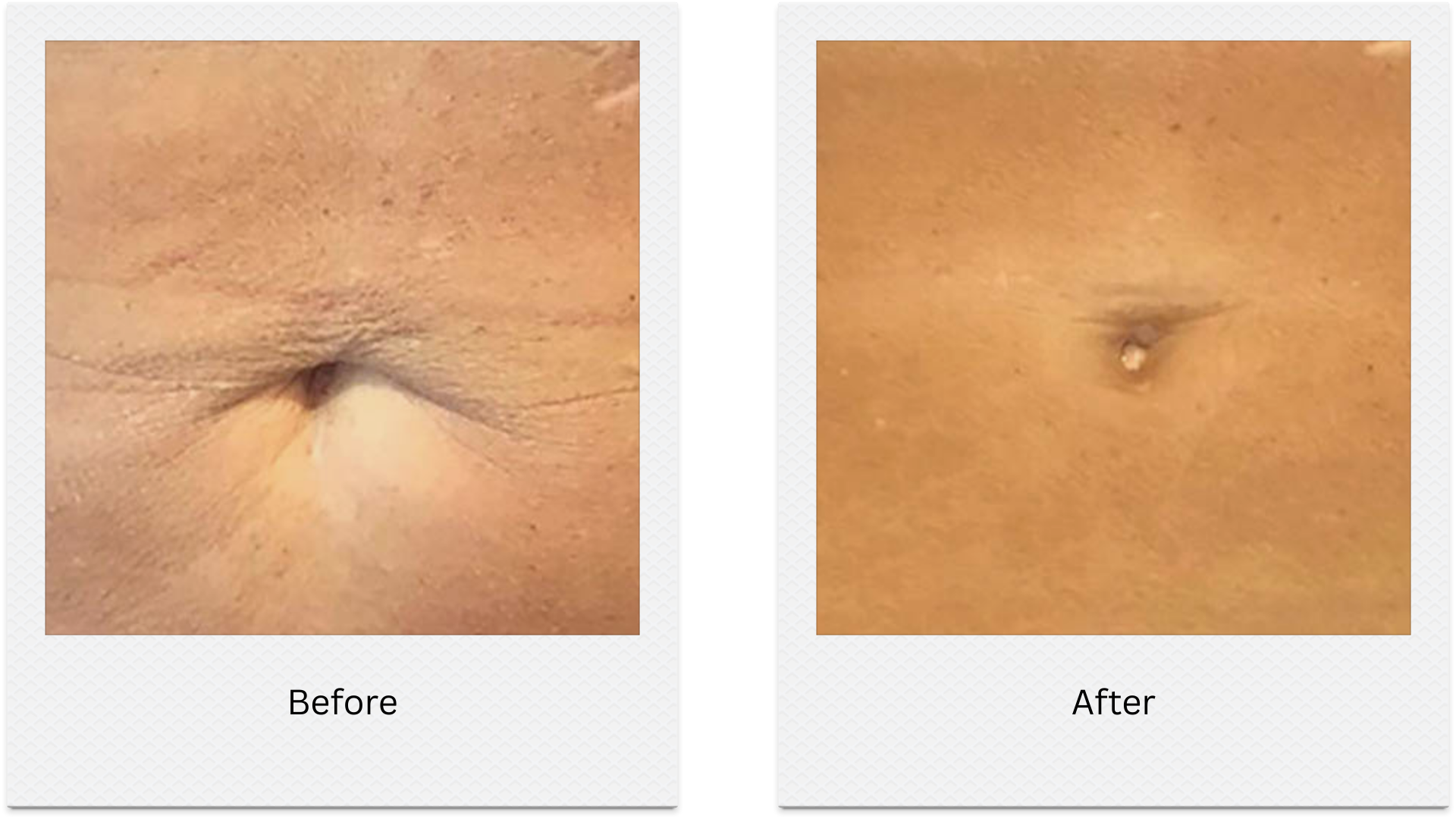 hifu neck tightening before after