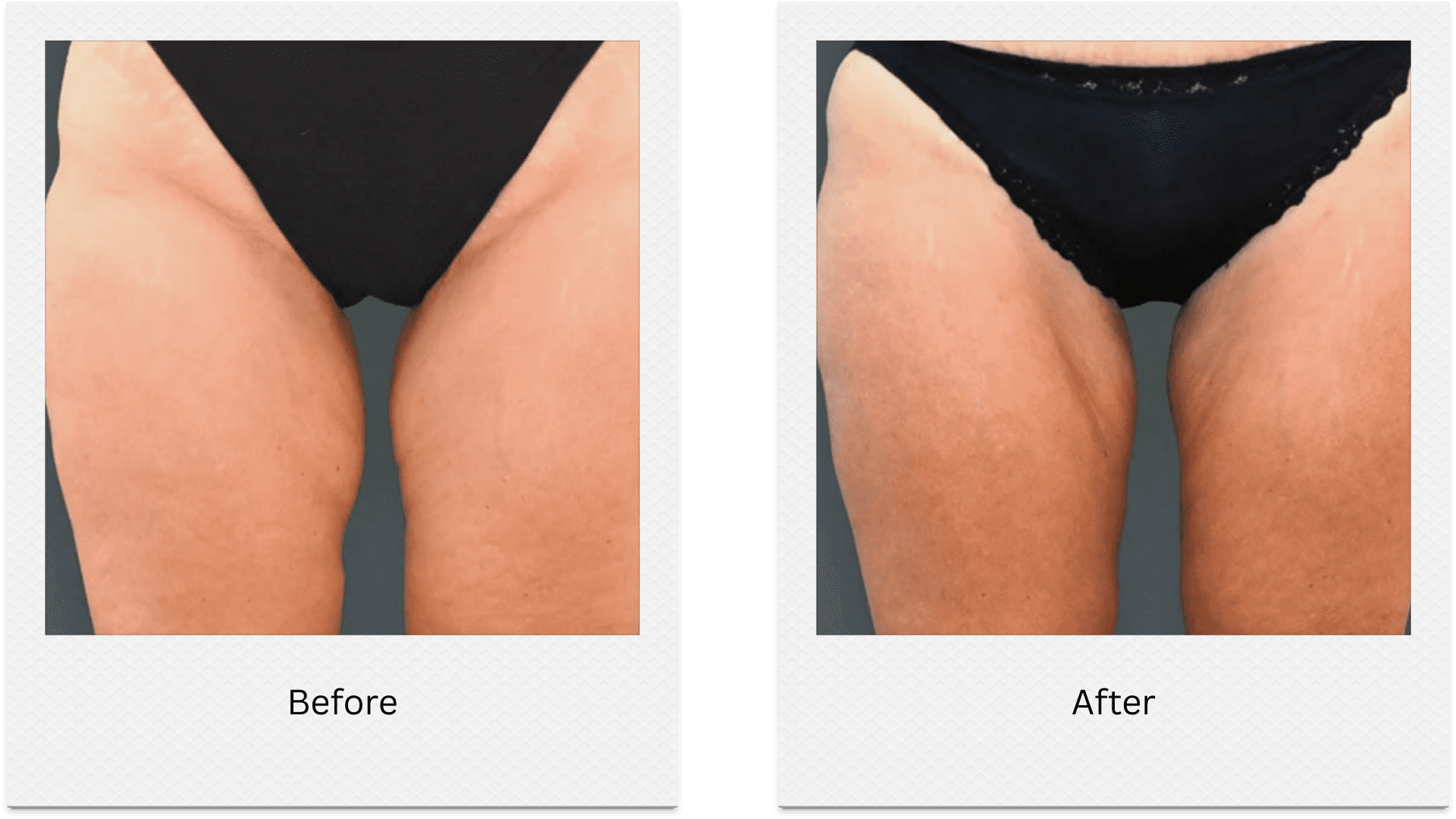 Inner thigh fat freezing before after results with slimmer thighs