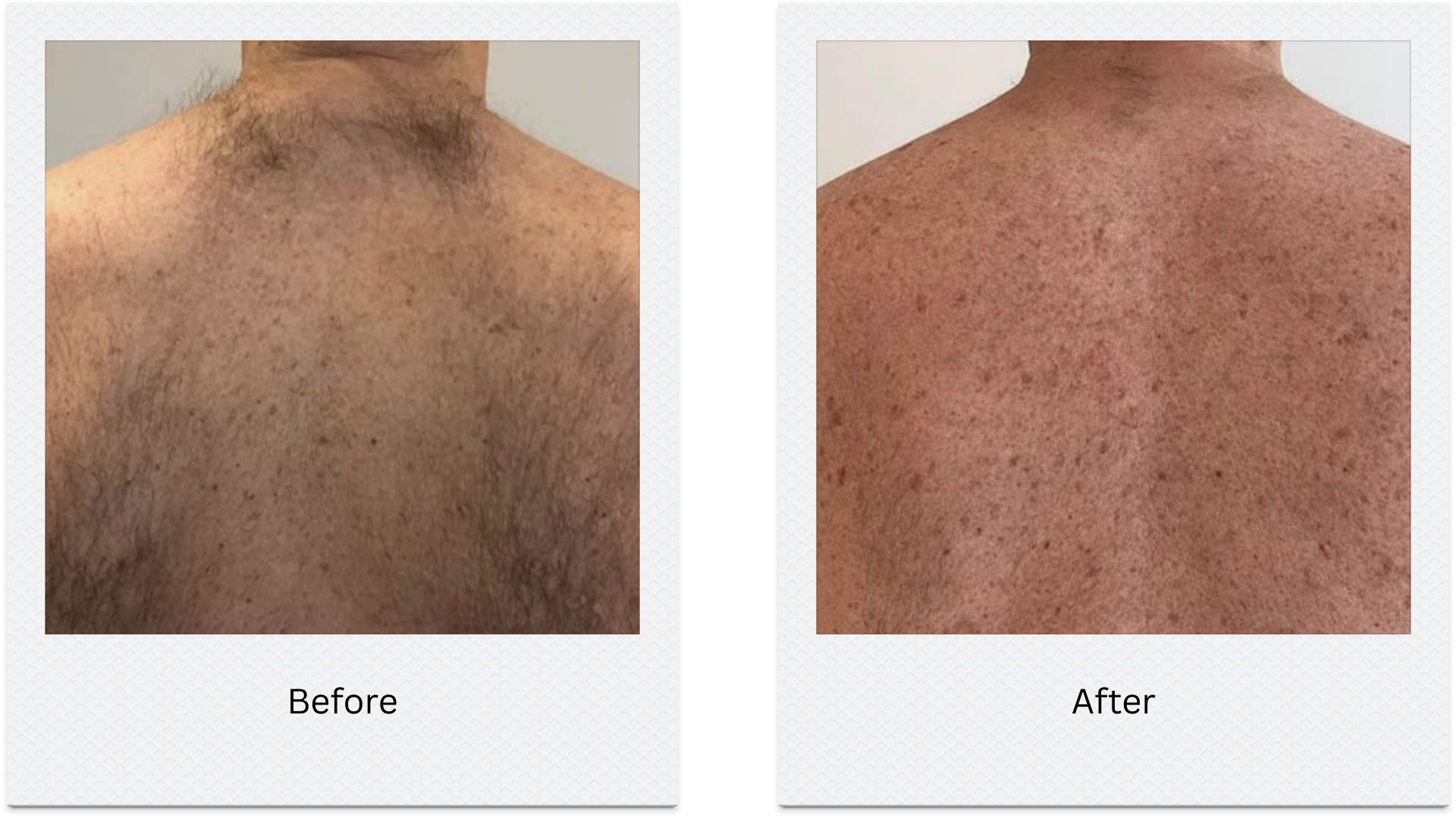 laser hair removal back before after