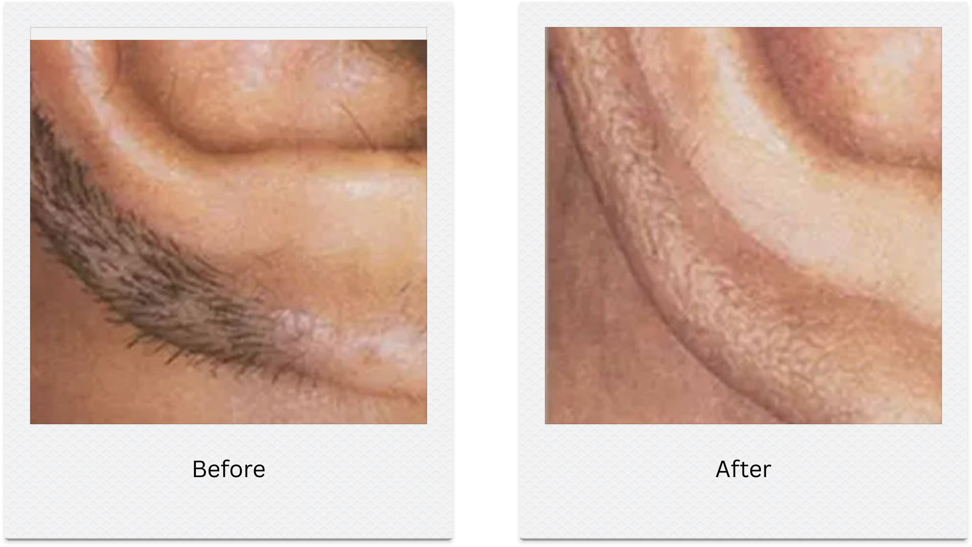 laser hair removal beard line before after