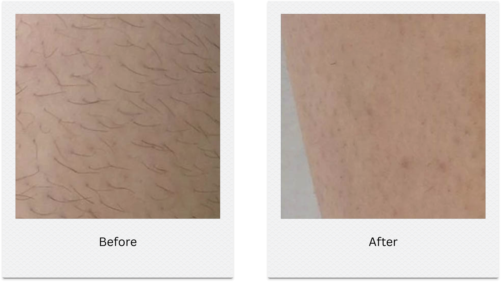 laser hair removal body leg before after