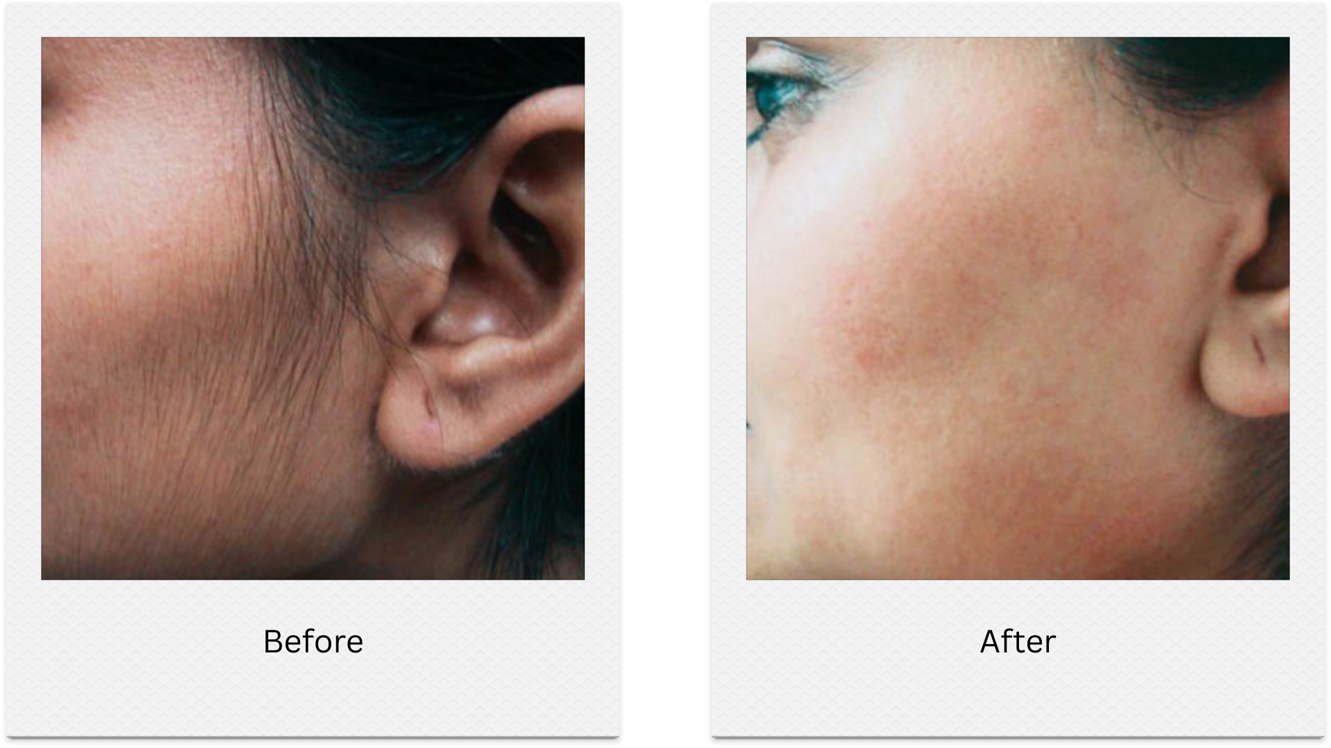 laser hair removal face sideburn before after