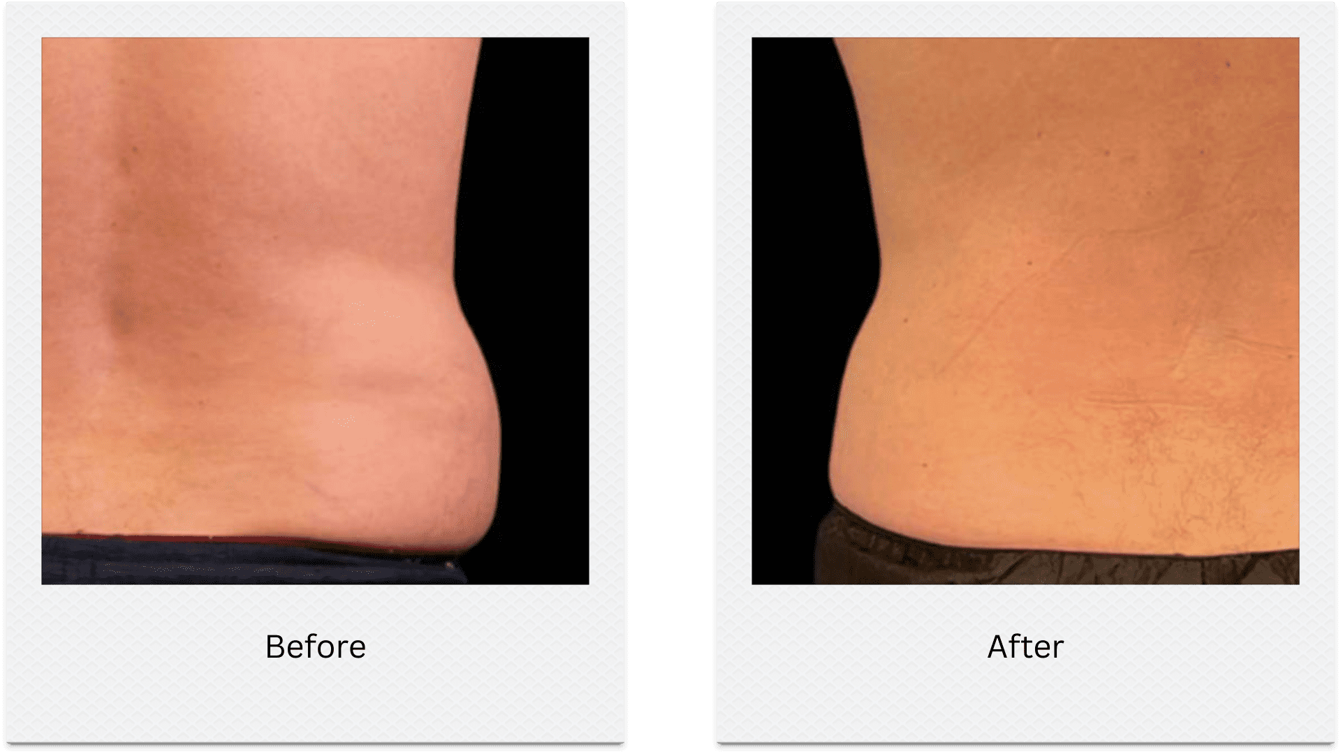 Love handles fat freezing before after side waist reduction