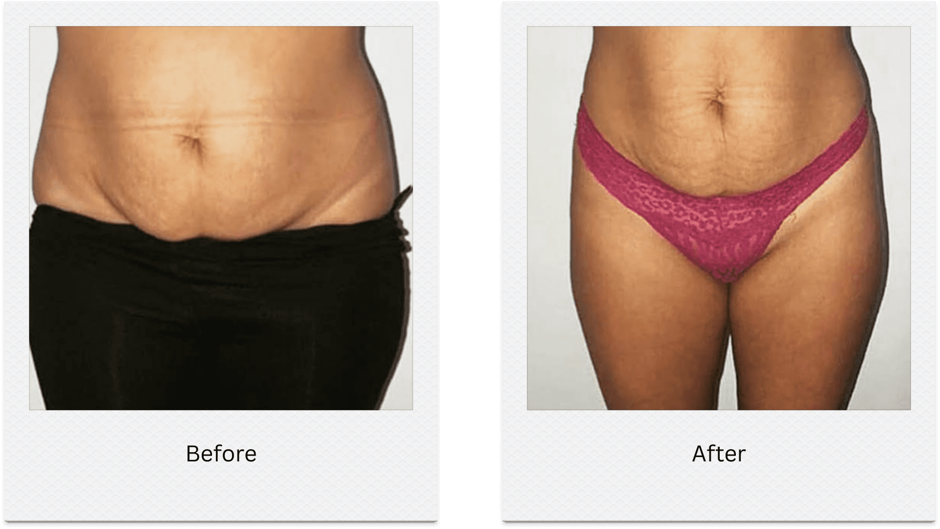 Lower abdomen fat freezing before after results flat stomach