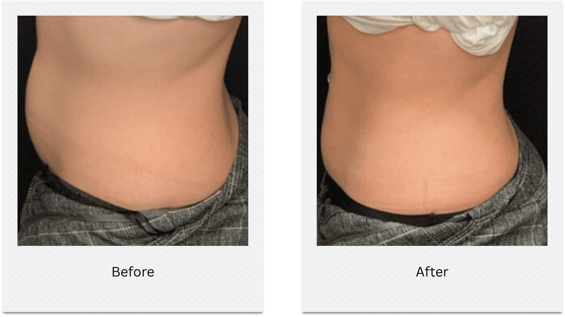 Lower belly fat freezing before after results showing fat reduction