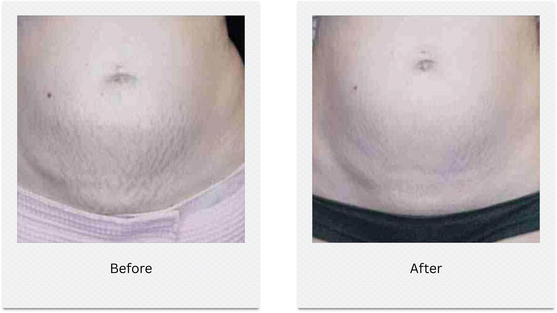 morpheus8 abdomen skin tightening before after