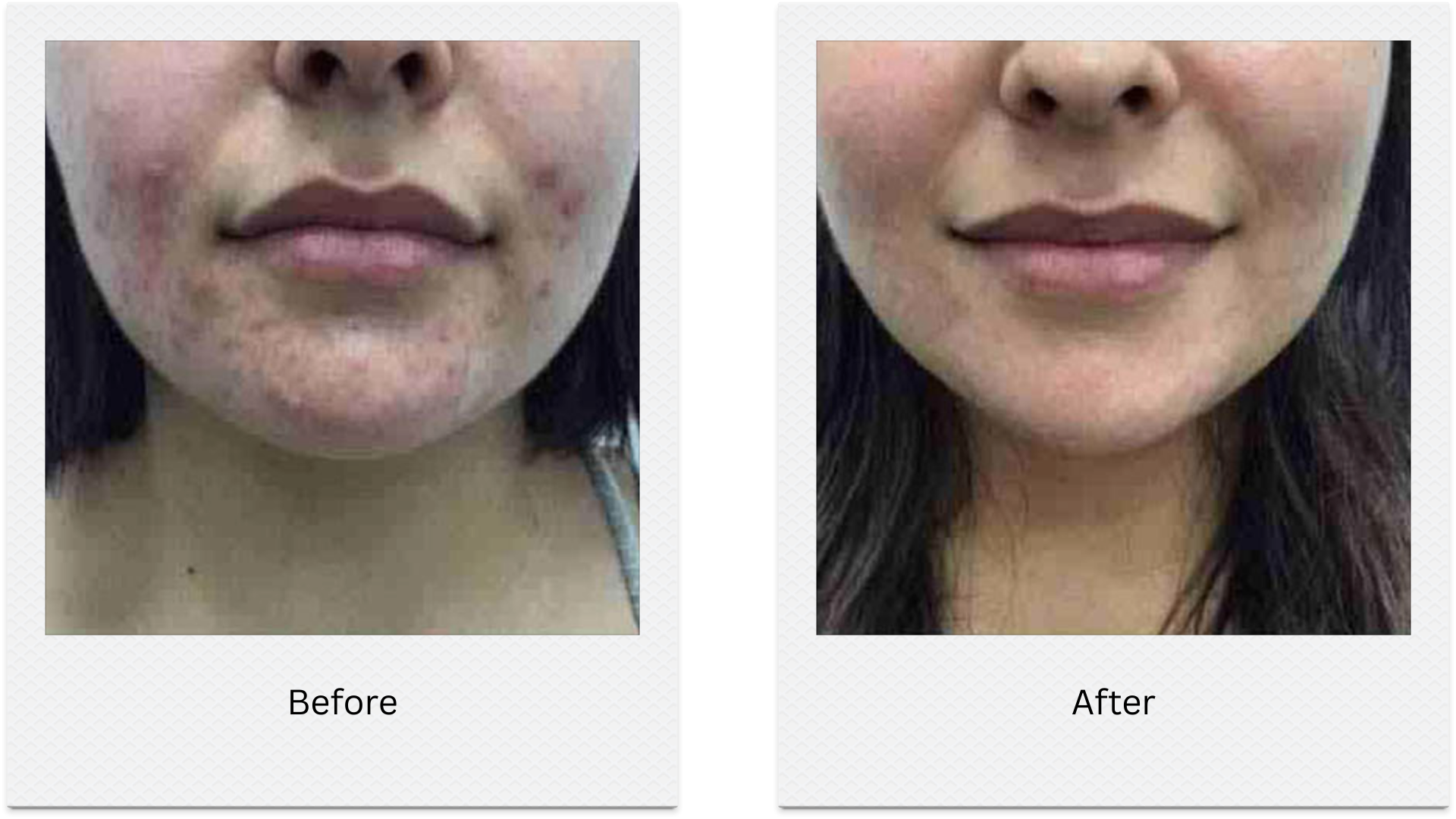 morpheus8 acne skin texture before after