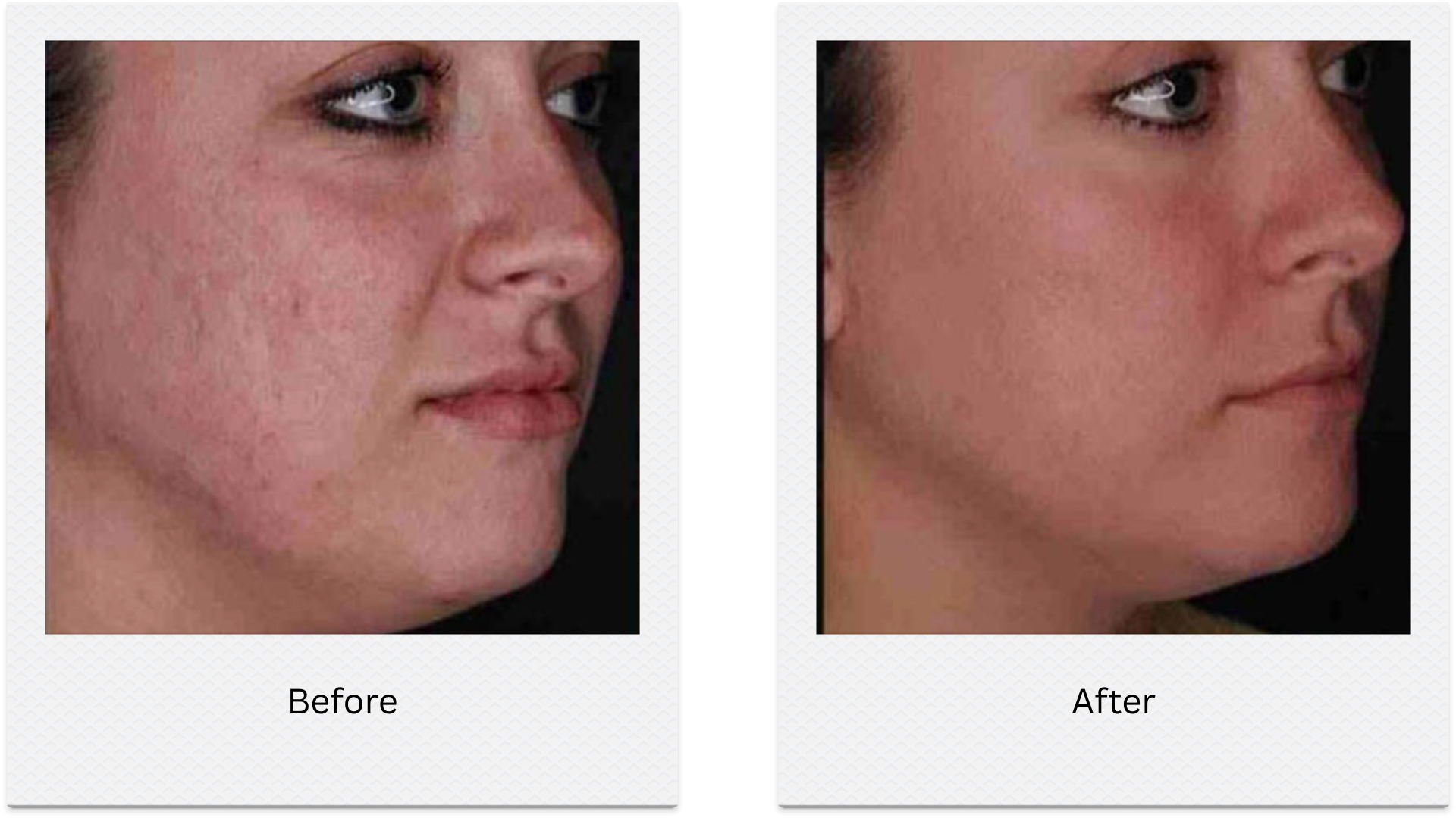 morpheus8 face contouring before after