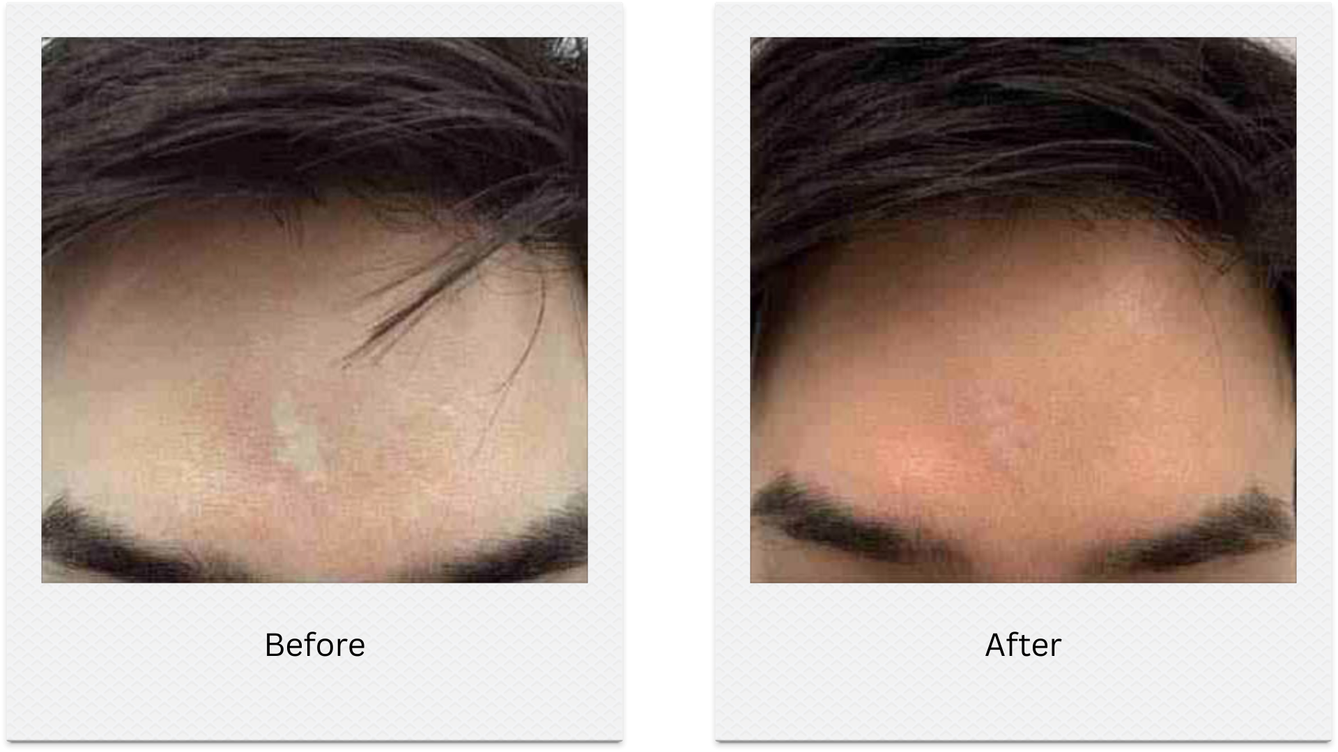 morpheus8 forehead skin rejuvenation before after
