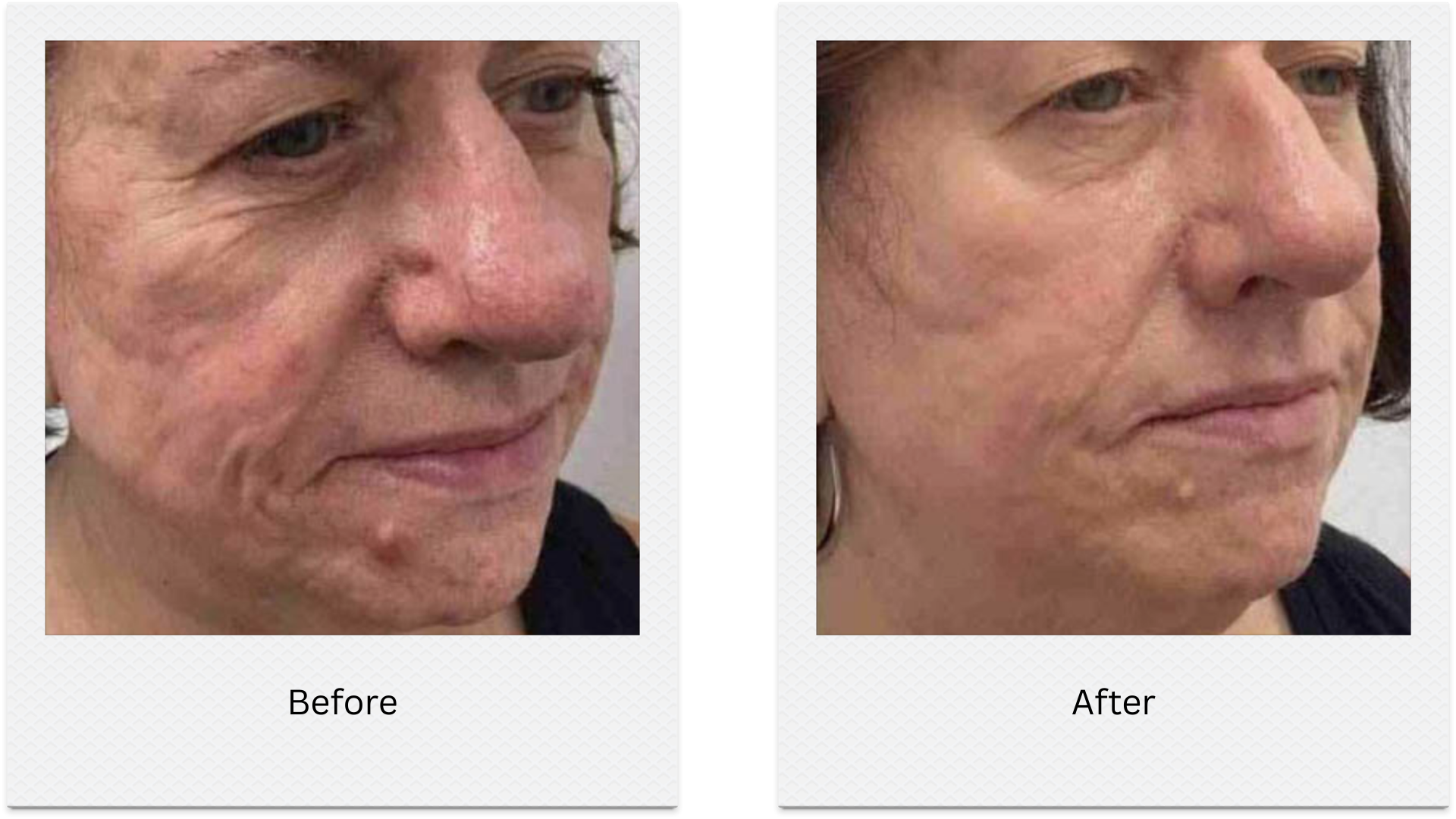 morpheus8 full face anti aging before after