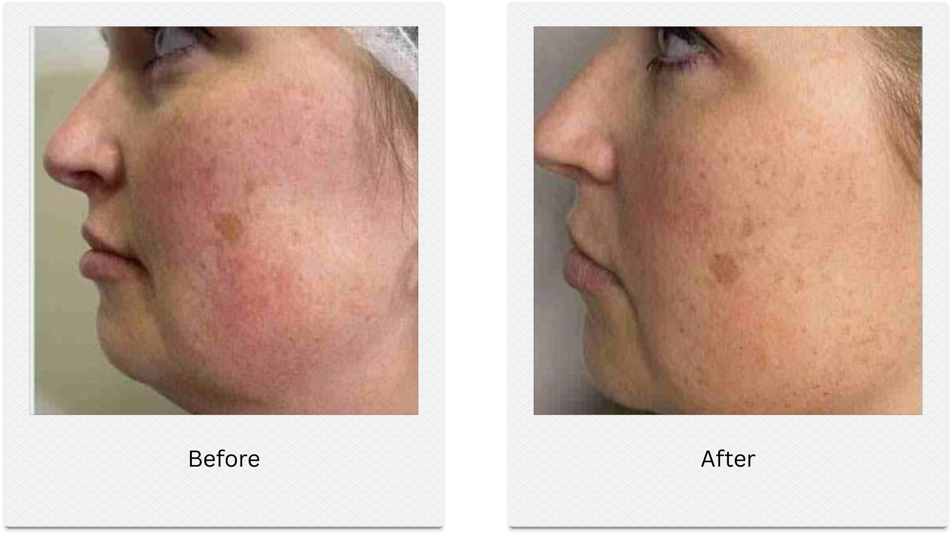 morpheus8 jawline contouring before after