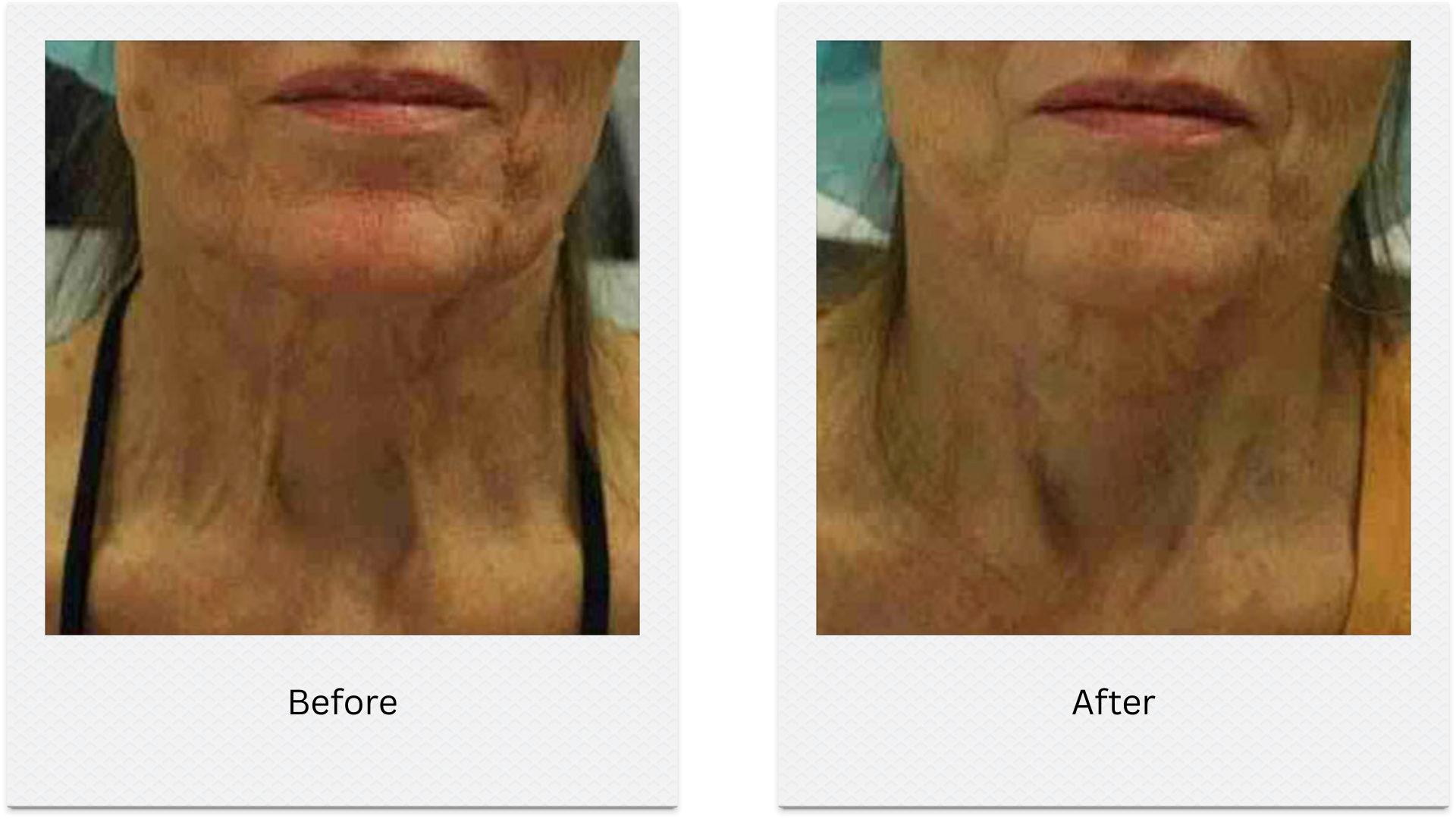 morpheus8 neck tightening before after