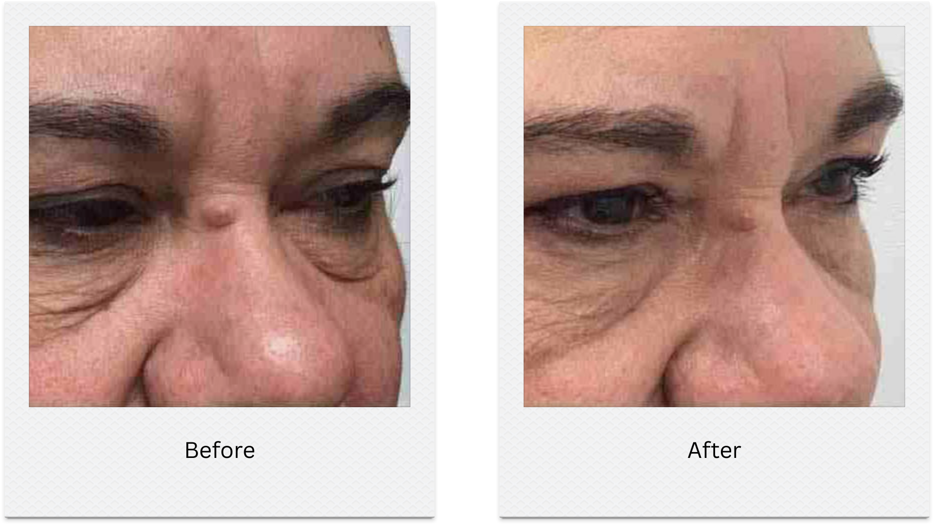 morpheus8 under eye skin tightening before after