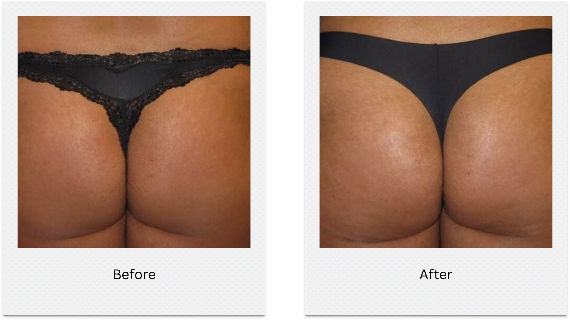 Non surgical Brazilian bum lift before after results showing lifted buttocks