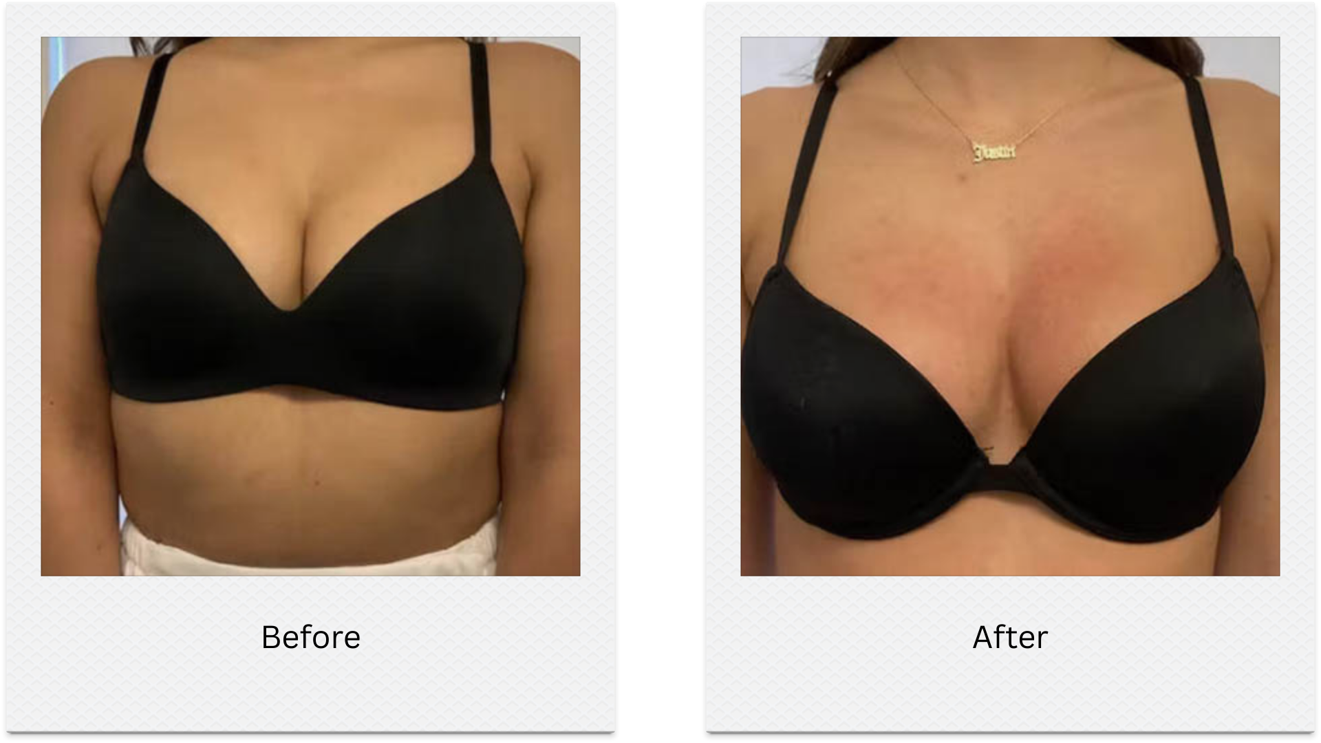 non surgical breast lift before after