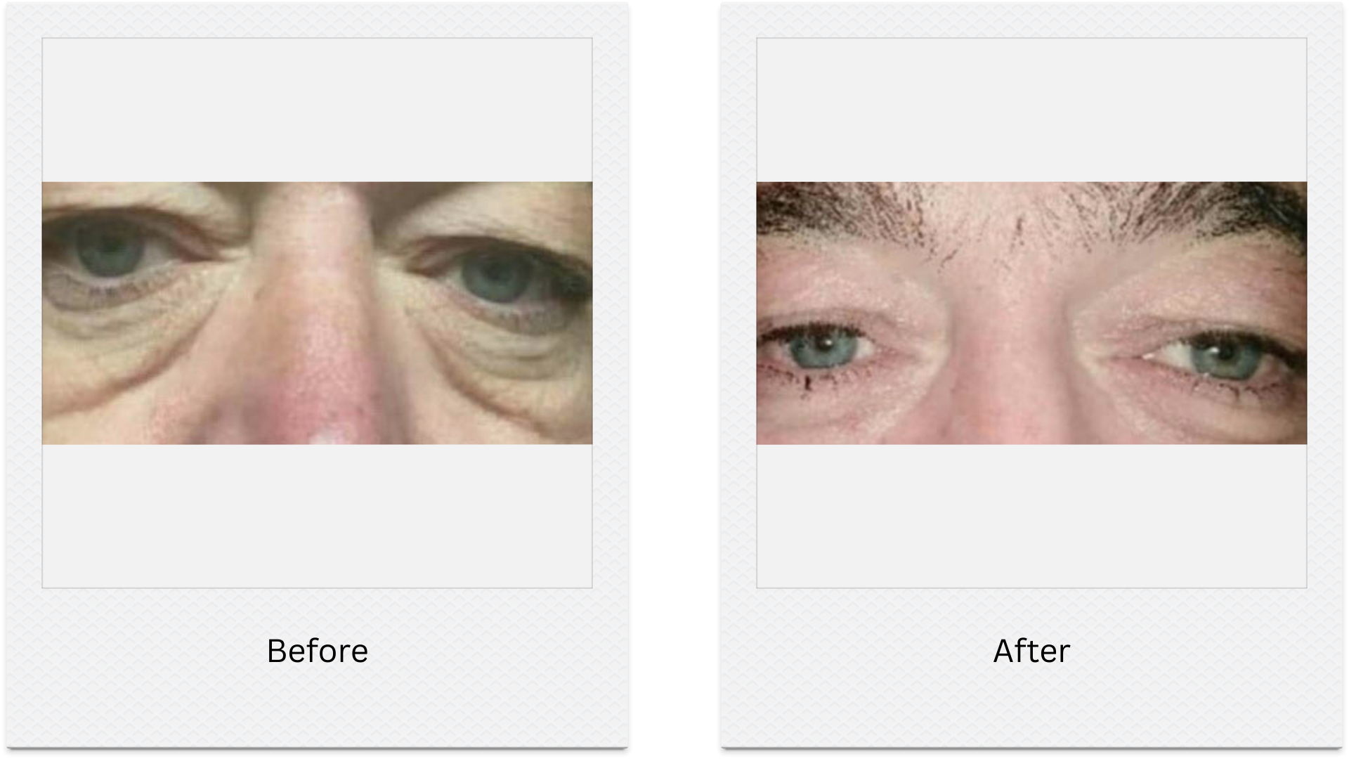 plasma eye lift eyelid tightening before after